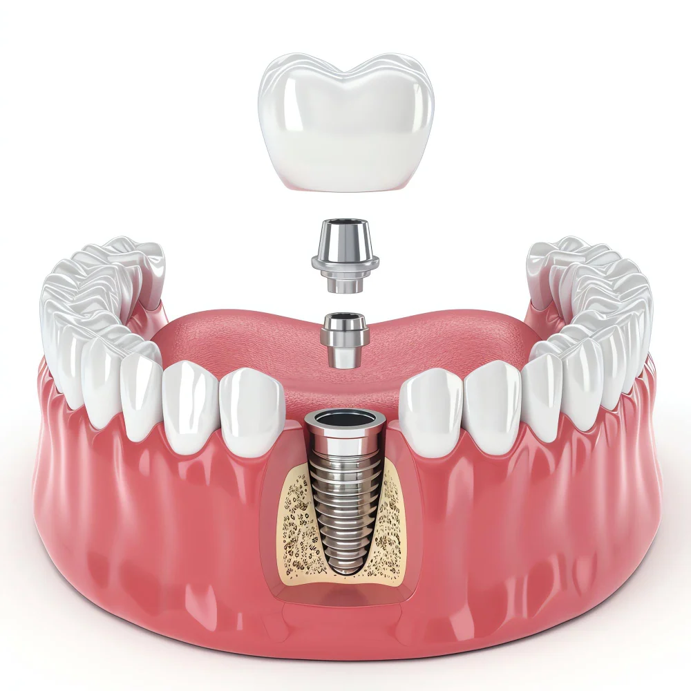 Dental Implants in Banashankari