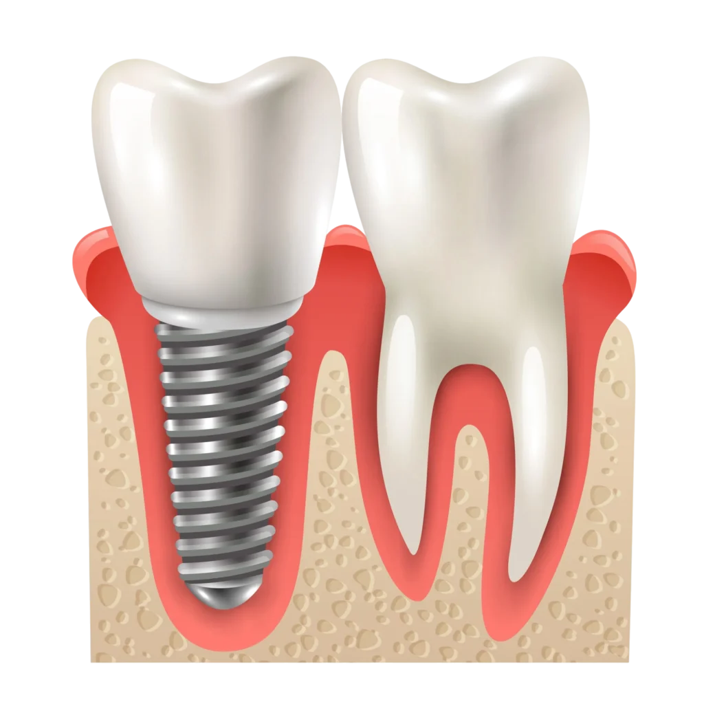Dental Implants in Banashankari